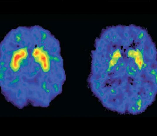 Efectele celor mai consumate droguri asupra creierului